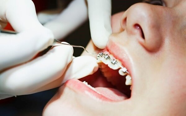 Độ tuổi phù hợp nhất để chỉnh răng là từ 12-14 tuổi