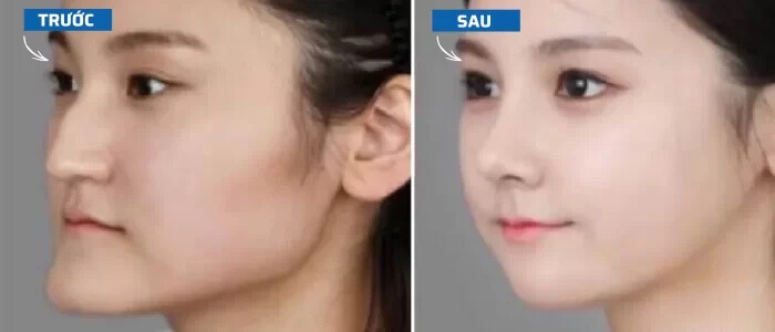 Thay đổi cằm trước và sau khi niềng răng