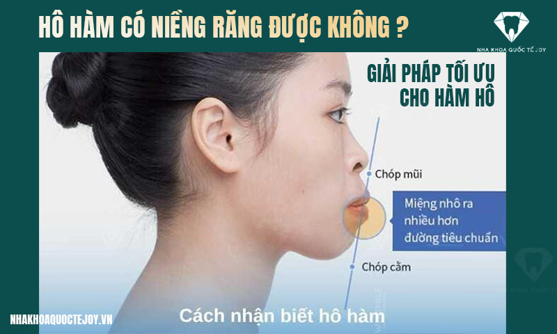 Hô hàm có niềng răng được không? Giải pháp tối ưu cho hàm hô