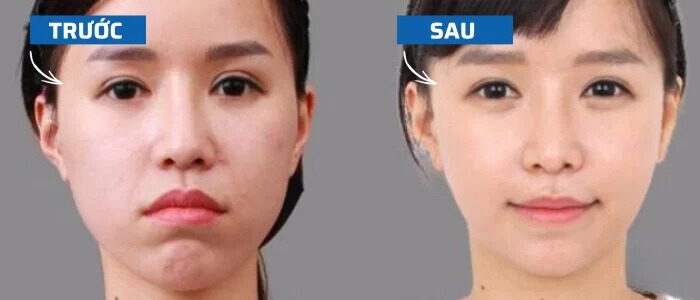 Thay đổi khuôn mặt sau khi niềng răng cũng có thể ảnh hưởng đến đôi môi