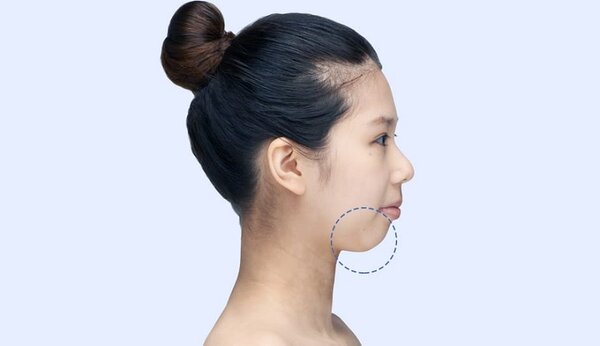 Cằm lẹm ảnh hưởng đến thẩm mỹ - Cằm lẹm niềng răng hiệu quả không?