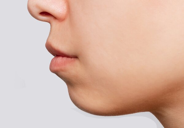 Cách nhận biết cằm lẹm - Cằm lẹm niềng răng hiệu quả không?