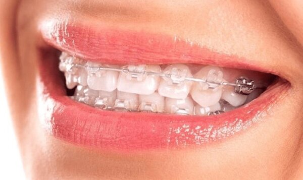 Chi phí cằm lẹm niềng răng đối với răng hô