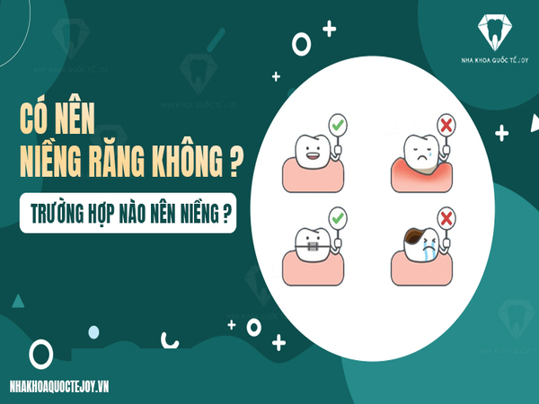 Có nên niềng răng không? Ưu điểm và nhược điểm của phương pháp niềng răng