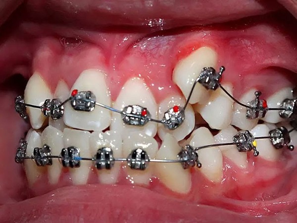 Răng thế nào thì nên niềng răng? Có nên niềng răng không?