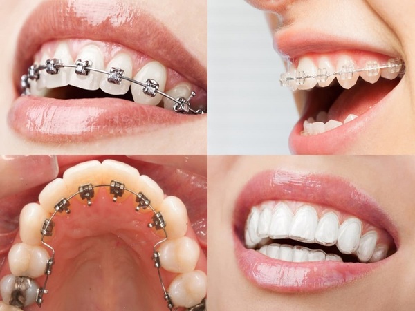 Các phương pháp niềng răng phổ biến hiện nay - Có nên niềng răng không?