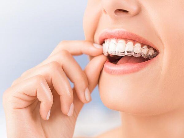 Các yếu tố quyết định bạn có nên niềng răng không?