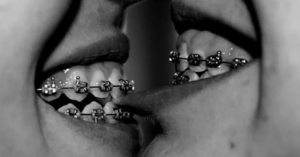 Đeo niềng răng có hôn được không?