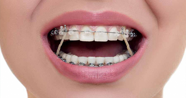 Khí cụ chỉnh nha