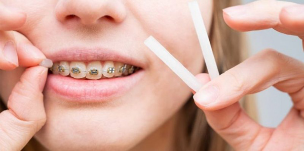 Sử dụng các sản phẩm hỗ trợ như sáp nha khoa