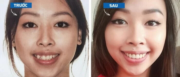 Sự thay đổi của xương hàm trước và sau khi niềng răng 
