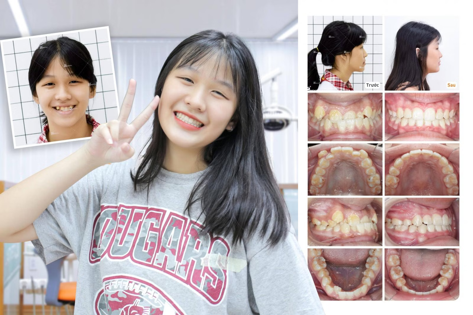 Niềng răng có làm thay đổi khuôn mặt trước và sau khi niềng răng hô