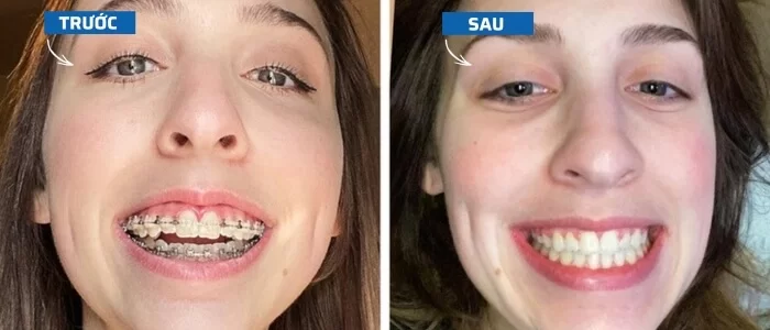 Niềng răng có làm thay đổi khuôn mặt trước và sau khi niềng răng hở