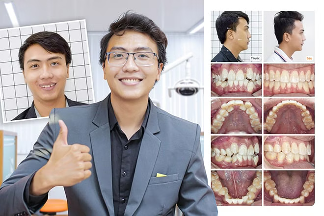 Niềng răng có làm thay đổi khuôn mặt trước và sau khi niềng răng lệch lạc, khấp khểnh
