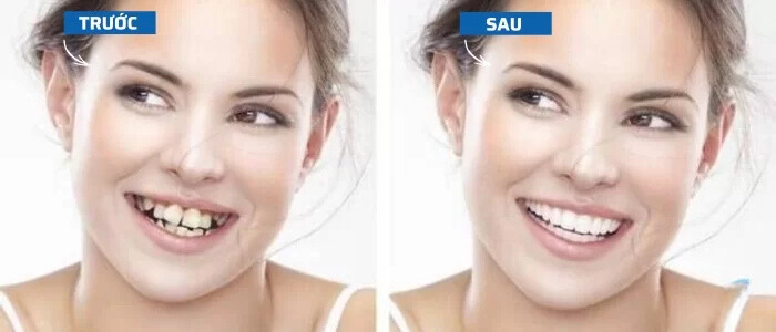 Niềng răng có làm thay đổi khuôn mặt trước và sau khi niềng răng ở người lớn