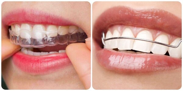 Các loại dụng cụ hàm duy trì phổ biến hiện nay