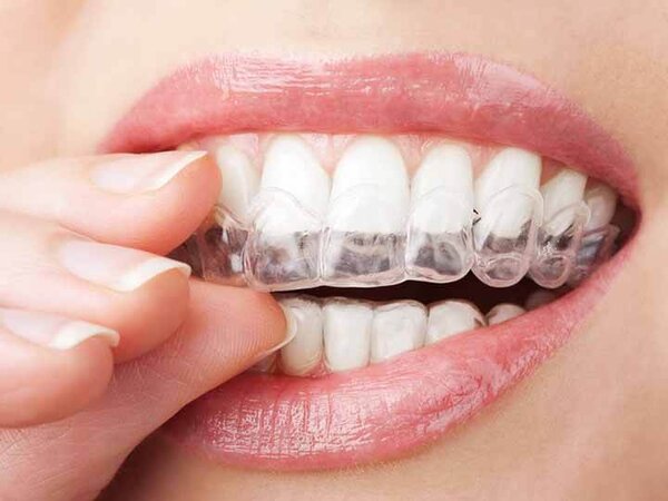Cách rút ngắn thời gian đeo hàm duy trì hiệu quả