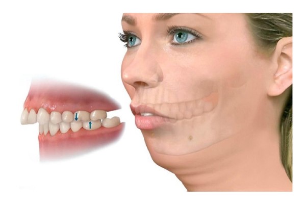 Răng hô là gì? Răng hô là gì?