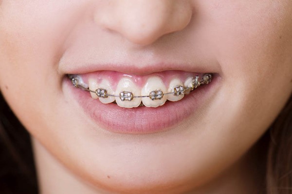Chi phí niềng răng hô là bao nhiêu? Chi phí niềng răng hô là bao nhiêu?