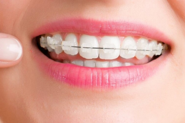 Niềng răng khểnh mắc cài sứ