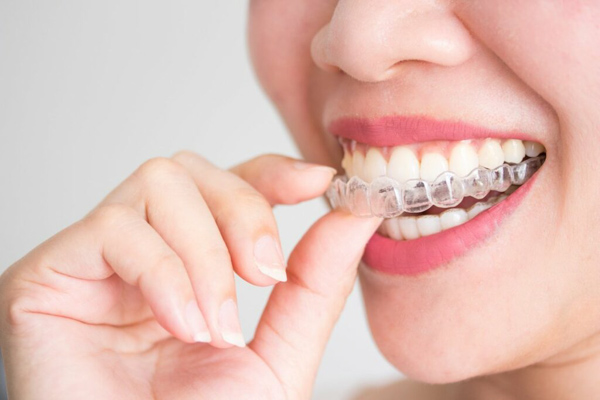 Niềng răng khểnh trong suốt Invisalign