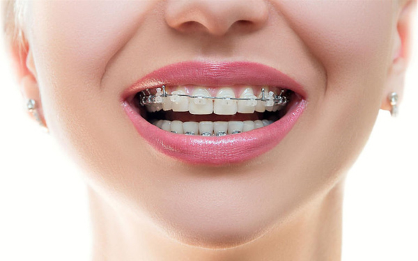 Niềng răng mắc cài pha lê là gì?