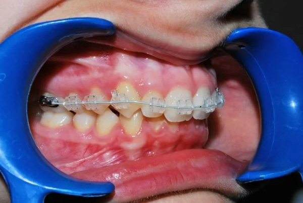 Hạn chế của niềng răng mắc cài pha lê