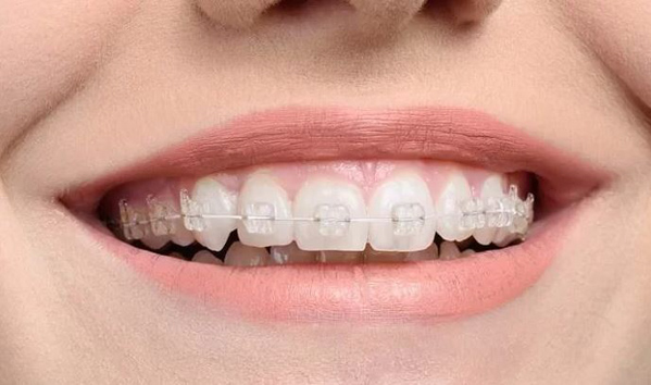 Đối tượng phù hợp niềng răng mắc cài pha lê