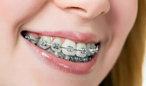 Thời gian niềng răng mắc cài sắt là bao lâu?