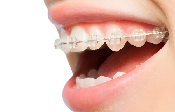 Ưu điểm của niềng răng mắc cài trong suốt Ưu điểm của niềng răng mắc cài trong suốt