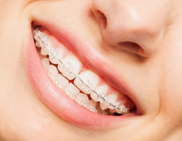 Hạn chế của niềng răng mắc cài trong suốt Hạn chế của niềng răng mắc cài trong suốt