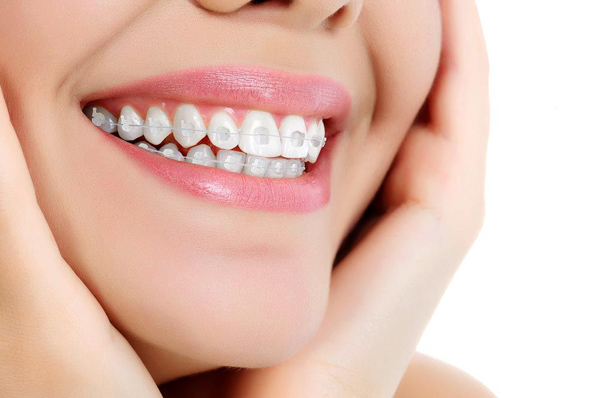 Niềng răng mắc cài pha lê Niềng răng mắc cài pha lê