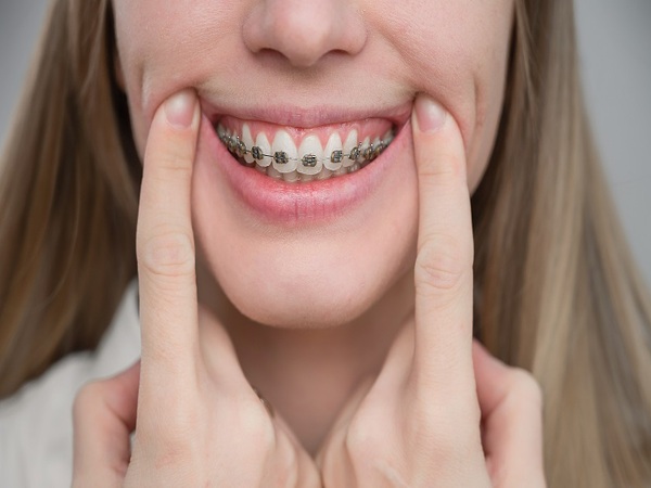 Một số tác hại của việc tự niềng răng tại nhà Một số tác hại của việc tự niềng răng tại nhà