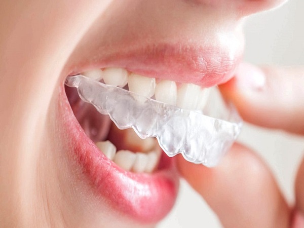 Những điều cần lưu ý khi niềng răng tại nhà bạn cần nắm rõ Những điều cần lưu ý khi niềng răng tại nhà bạn cần nắm rõ
