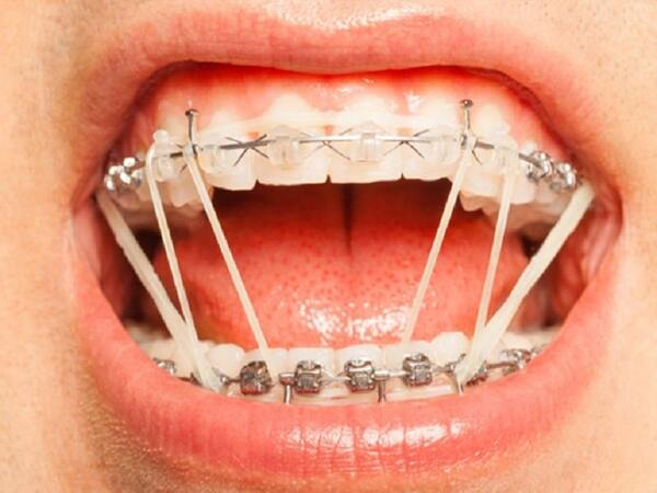 Niềng răng tại nhà với dây chun Niềng răng tại nhà với dây chun