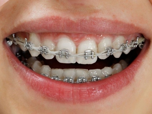 Niềng răng tại nhà với dây thép tự chế Niềng răng tại nhà với dây thép tự chế
