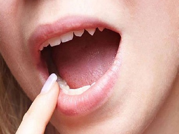 Niềng răng tại nhà bằng cách đẩy răng bằng tay Niềng răng tại nhà bằng cách đẩy răng bằng tay
