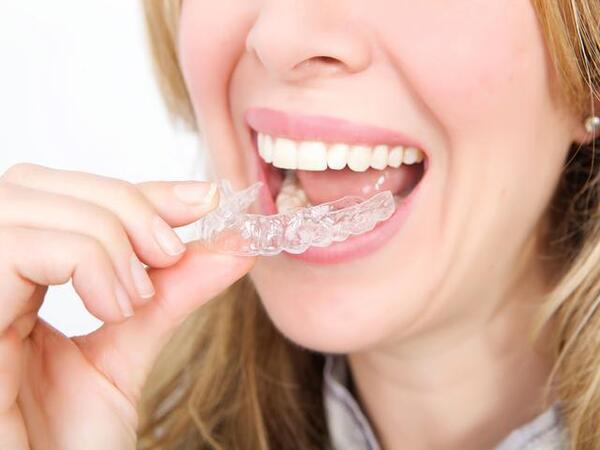 Niềng răng bằng khay trong suốt tự chế Niềng răng bằng khay trong suốt tự chế