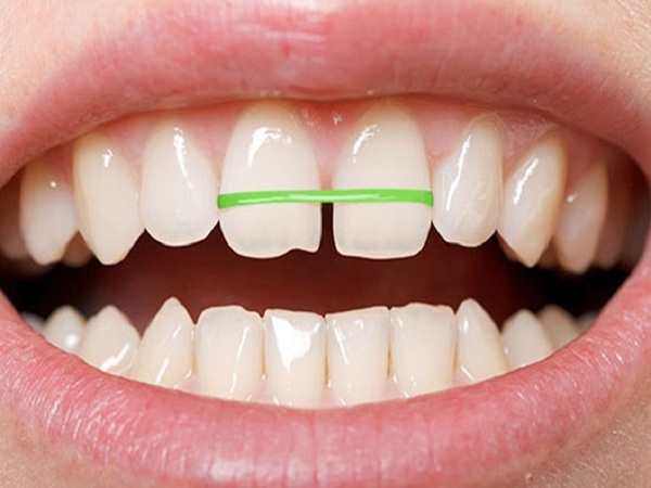 Tự niềng răng tại nhà có nguy hiểm gì không? Tự niềng răng tại nhà có nguy hiểm gì không?
