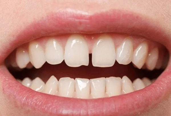 Răng thưa là gì?