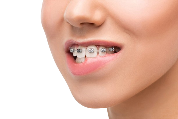 Niềng răng thưa bằng mắc cài kim loại