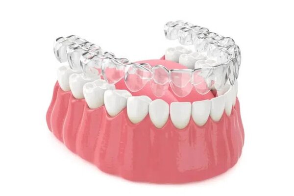 Quy trình niềng răng trong suốt chuẩn y khoa