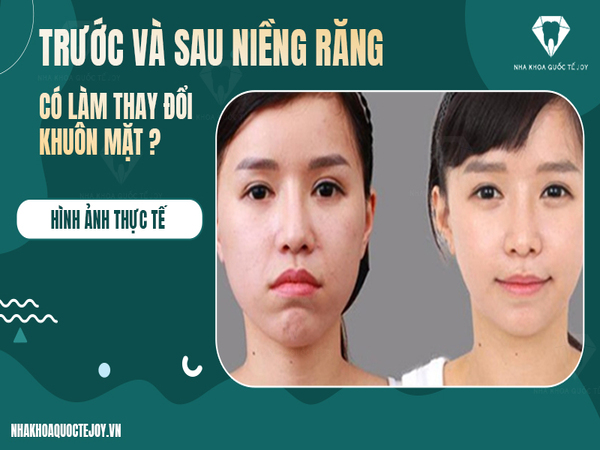 Niềng răng có làm thay đổi khuôn mặt không?