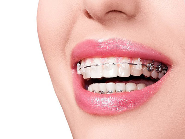 Những điều cần lưu ý khi niềng răng - Niềng răng có làm thay đổi khuôn mặt không?