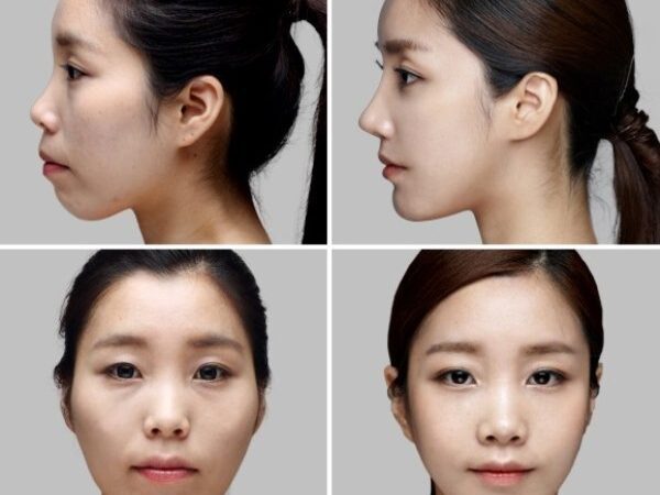 Niềng răng có làm thay đổi khuôn mặt và thay đổi như thế nào?