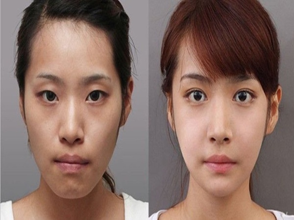 Niềng răng có làm thay đổi khuôn mặt trước và sau khi niềng răng móm 