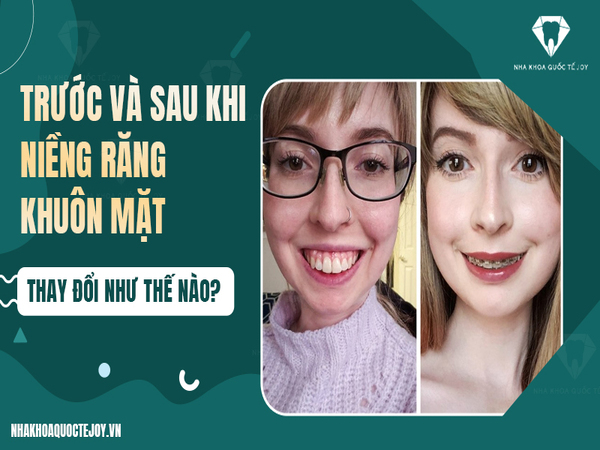 Hàm răng tác động đến sự thay đổi của khuôn mặt như thế nào? Trước và sau khi niềng răng