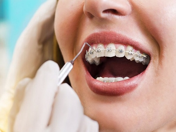 Những điều cần lưu ý trước và sau khi niềng răng