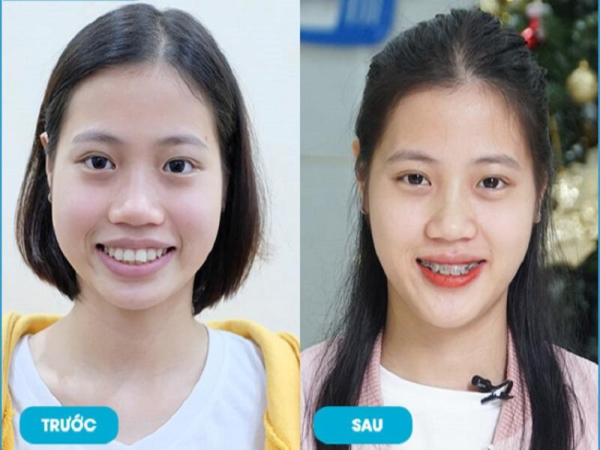 Niềng răng có làm khuôn mặt thay đổi không? Trước và sau khi niềng răng