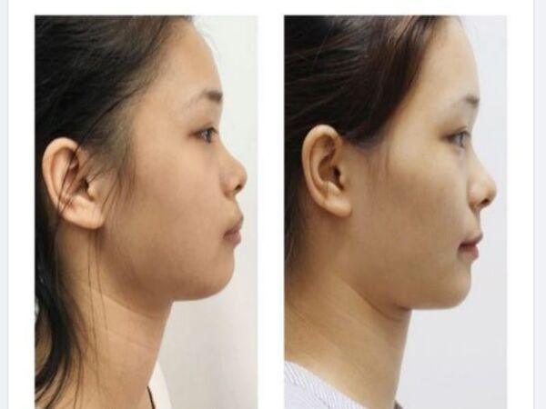 Các mức độ thay đổi của khuôn mặt trước và sau khi niềng răng